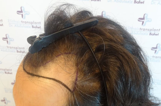 Haarausfall durch Sauerstoffmangel - Vor Haarverpflanzung bei Geheimratsecken natürliche Haarlinie angezeichnet