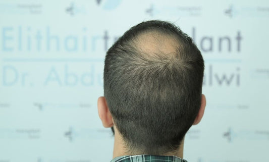 Haarausfall bei Colitis Ulcerosa - Behandlung bei Haarausfall Elithairtransplant